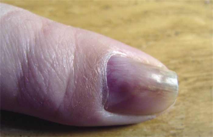 女子指尖藏瘤莫名剧痛10年 血管球瘤的症状有哪些