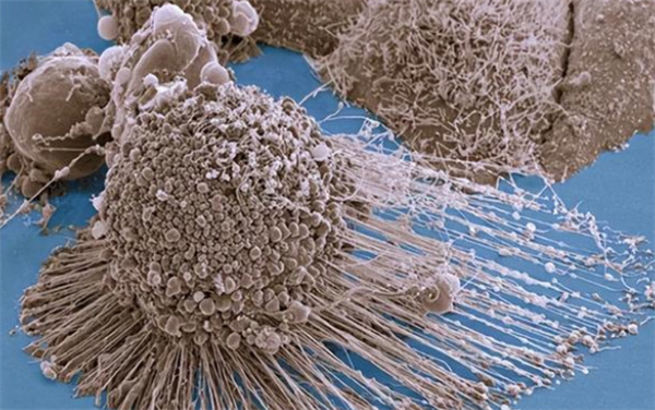 让人类害怕的癌细胞 为啥会永远不死？（癌细胞）